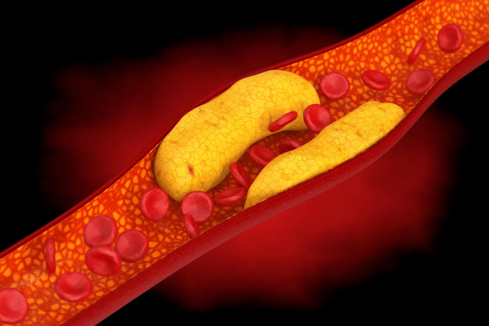 Hyperlipidemia / Dyslipidemia Banner