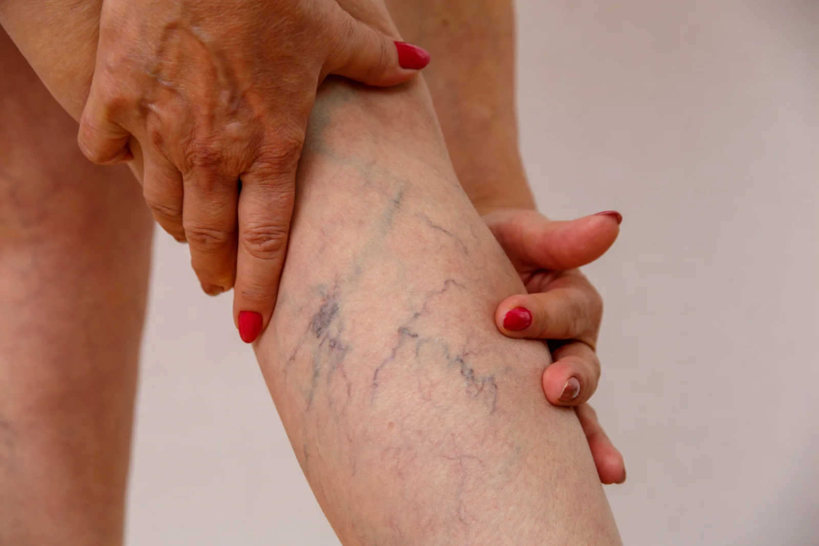 Varicose Vein Procedures (EVLT, Sclerotherapy, Stripping) Banner