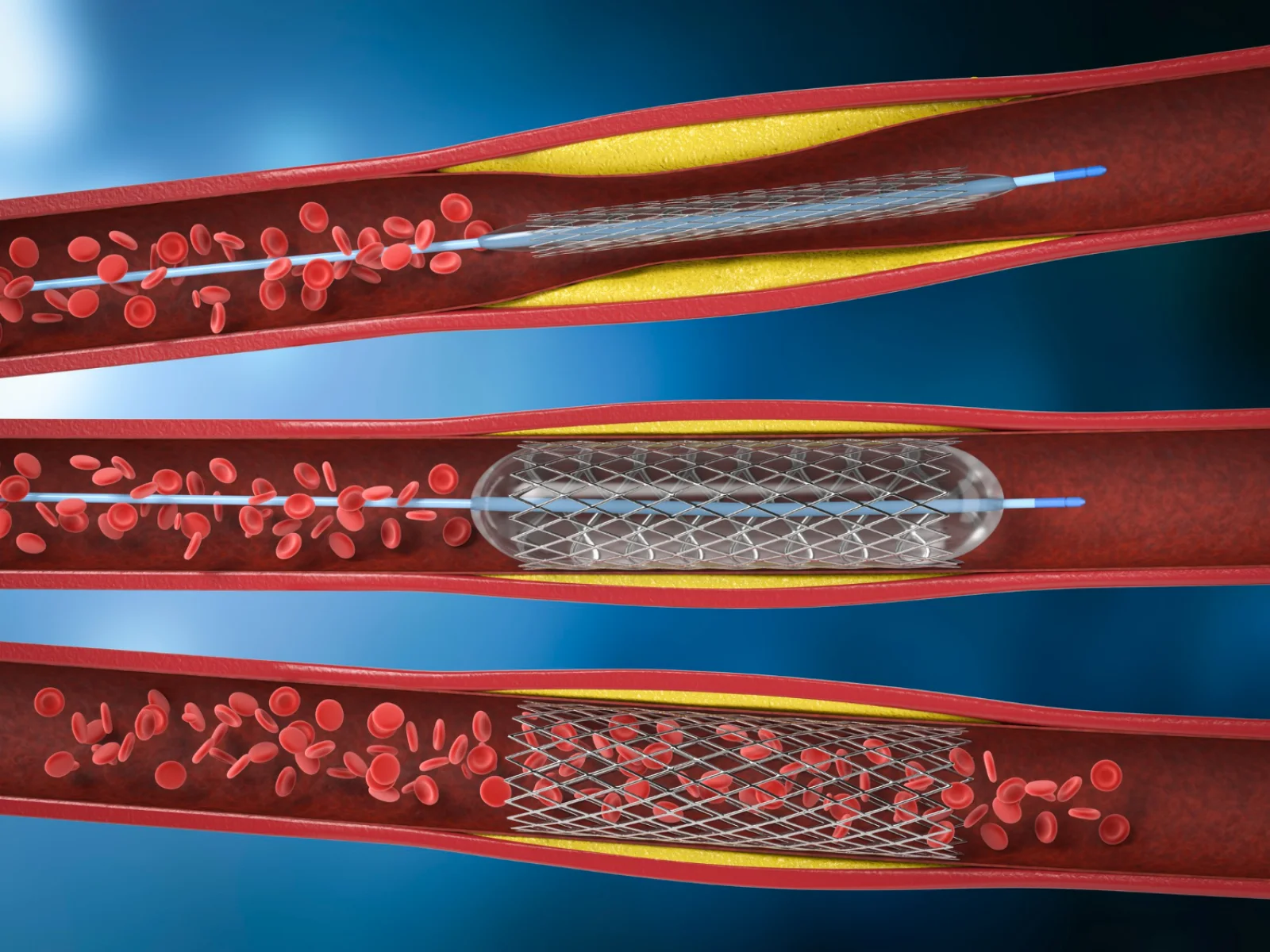 Revascularization Procedures (Endovascular / Surgical) Banner