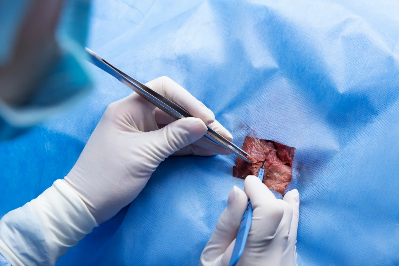 TURBT (Transurethral Resection of Bladder Tumor) Banner