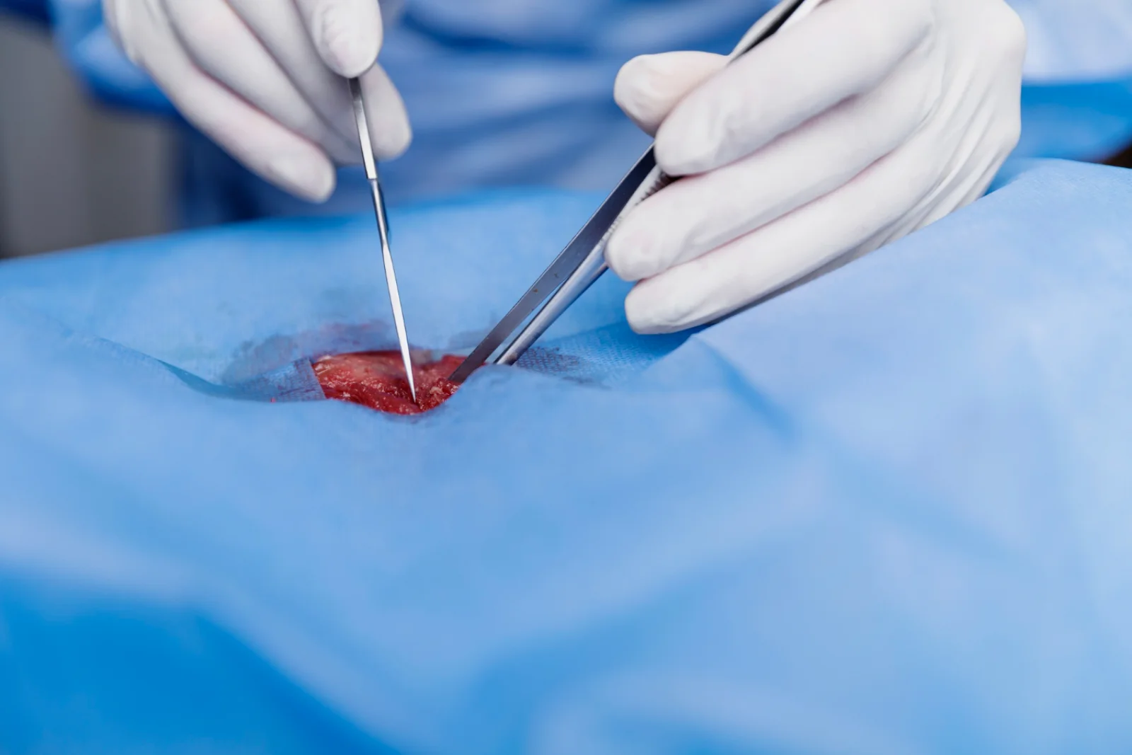 ERCP (Stone Extraction, Stent Placement) Banner