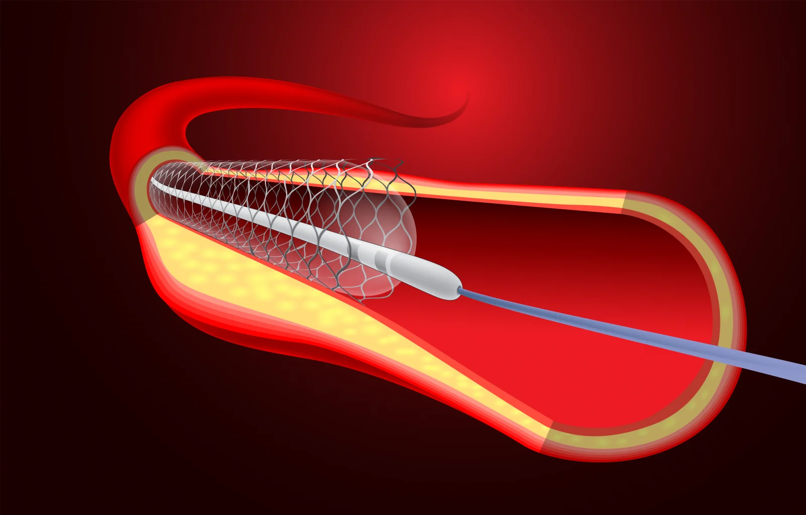 Carotid Artery Stenting Banner