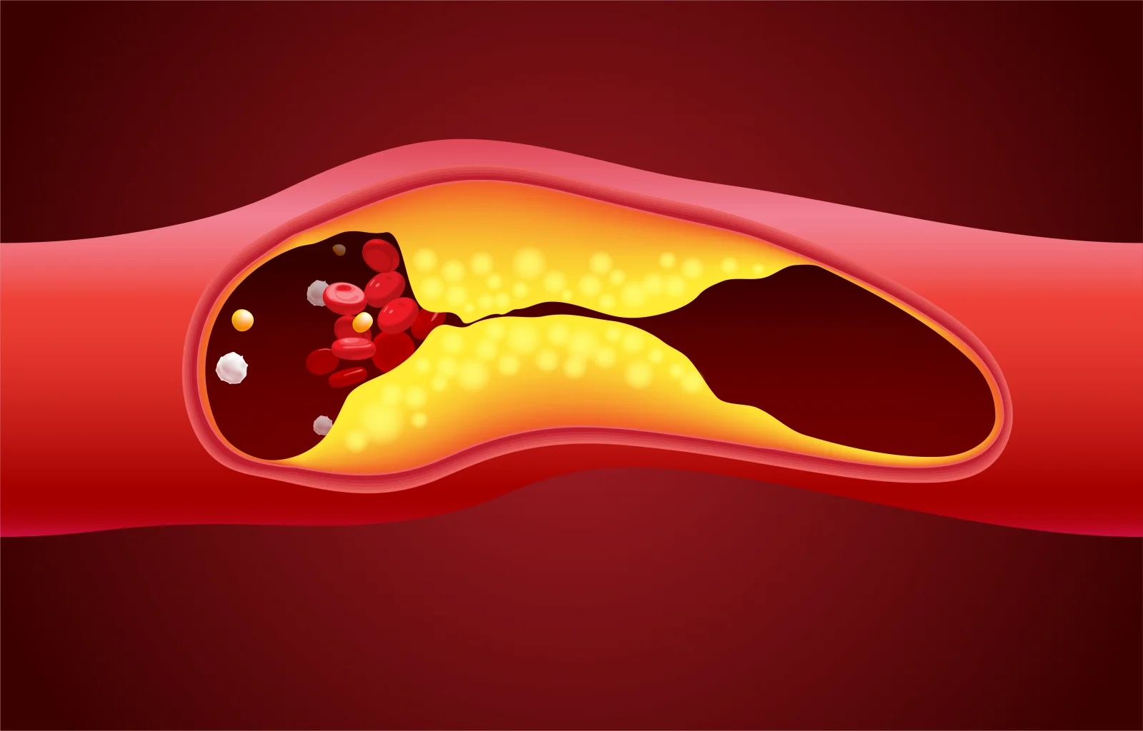 Lymphatic & Vascular Leak Management (e.g., Lymphocele) Banner