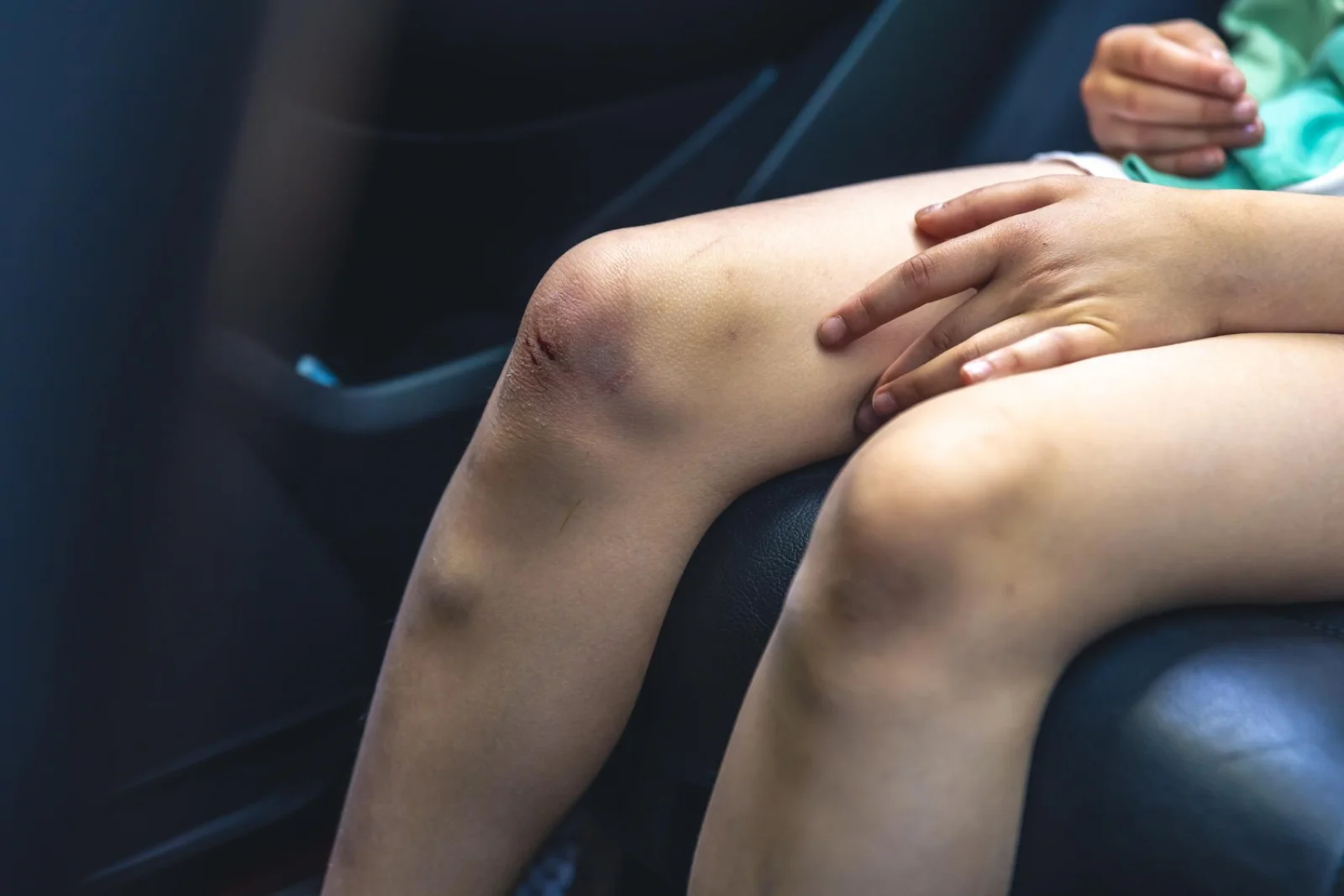 Varicose Vein Surgery (High Ligation, Stripping, Phlebectomy) Banner